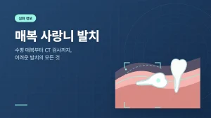 매복 사랑니 발치
